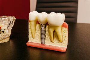 Dental Bridge vs Implant: Understanding the Functional Differences