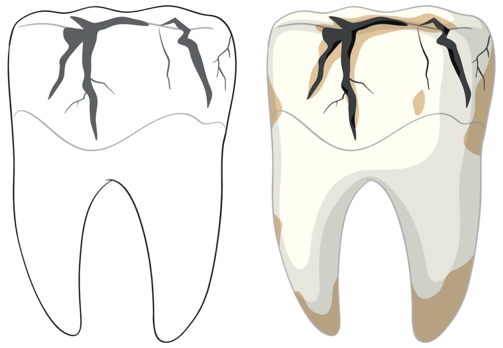 When Is a Cracked Tooth an Emergency?