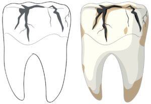 When Is a Cracked Tooth an Emergency?