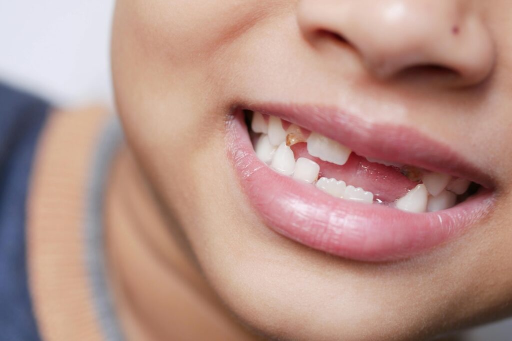 Why People Delay Replacing Missing Teeth